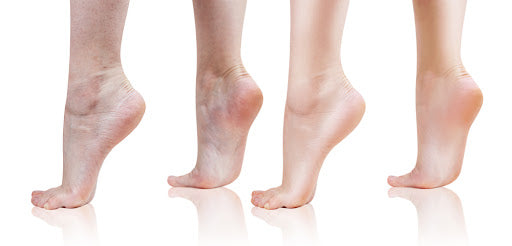 5 CONSEILS POUR LUTTER CONTRE LA PEAU SÈCHE ET LES CALLOSITÉS DES PIEDS