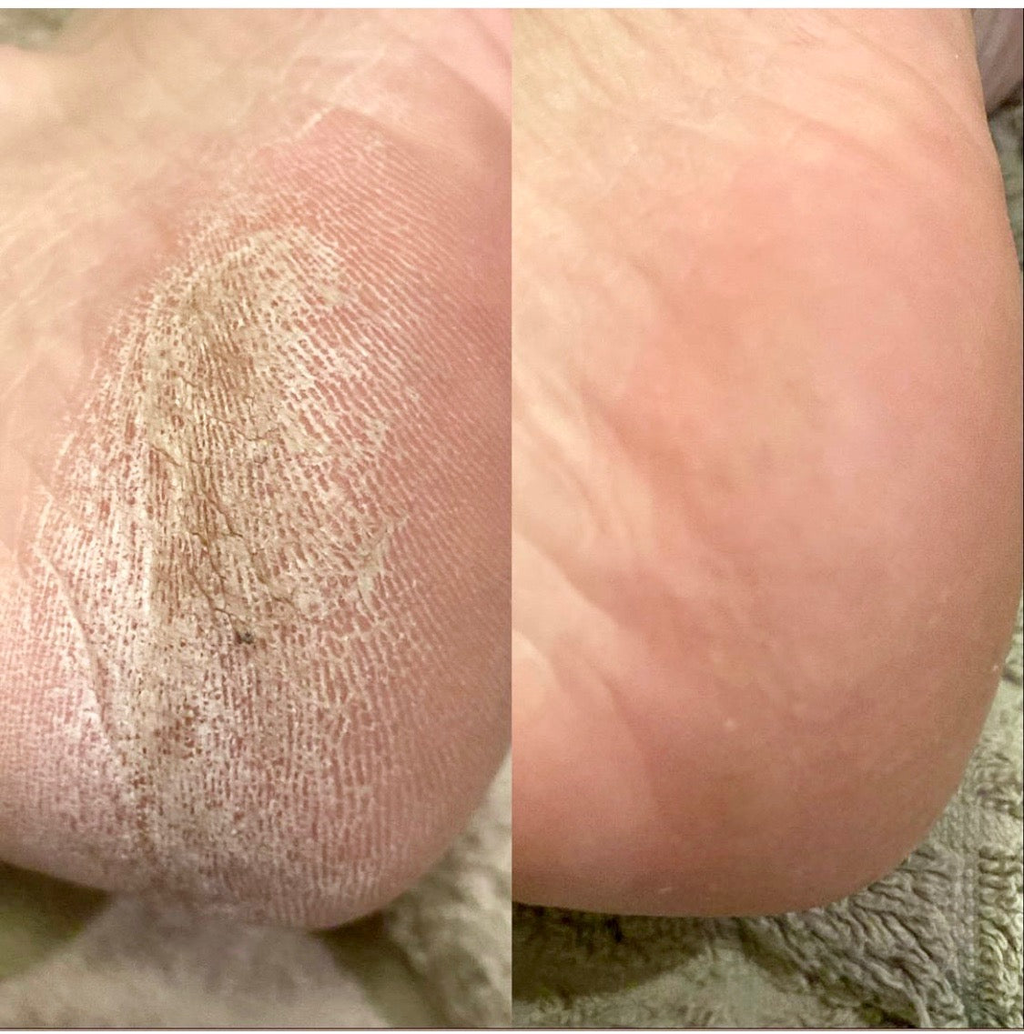 LOVASKIN PEELING INSTANTANÉ POUR LES PIEDS Spray 75 ml - 25 soins dans un flacon