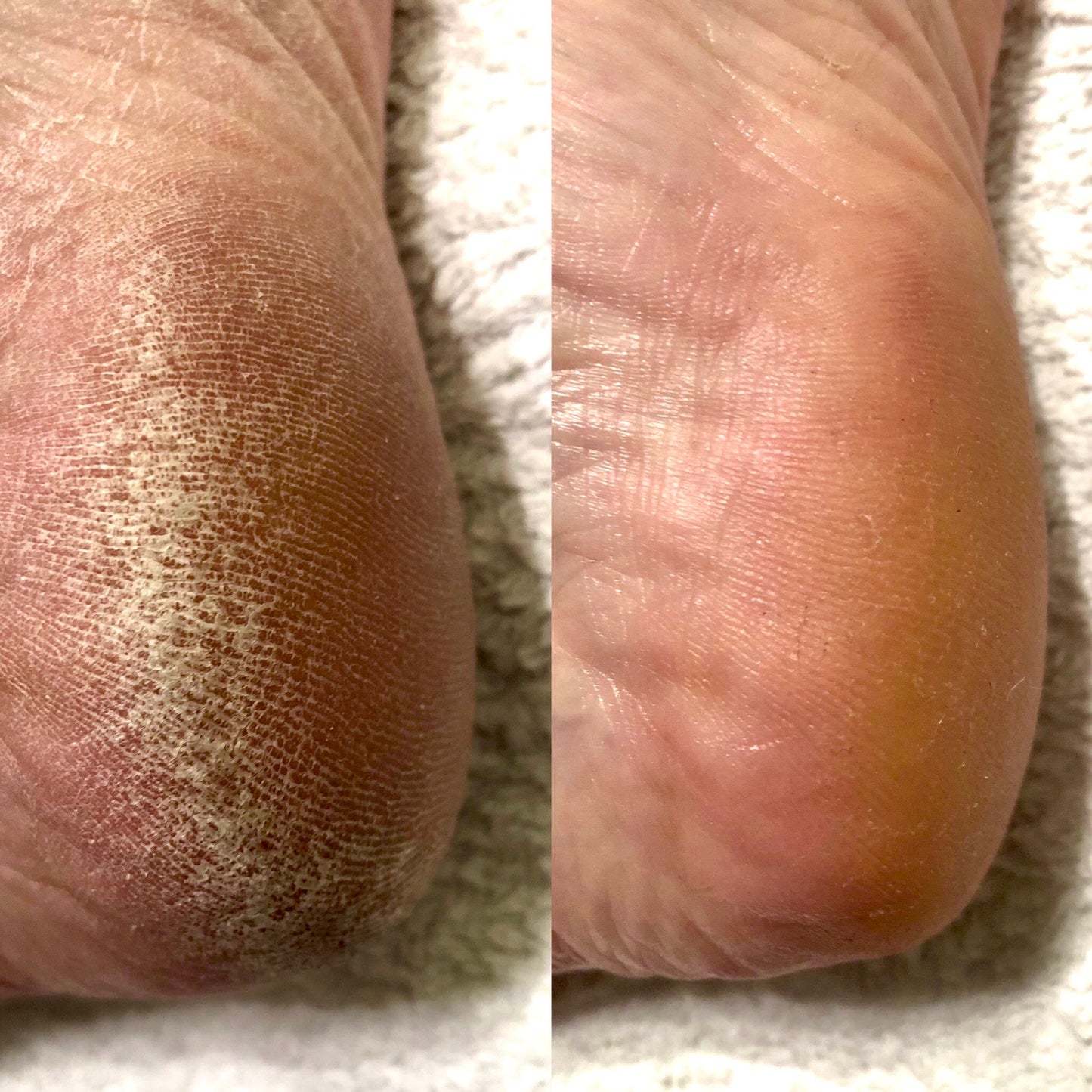 LOVASKIN INSTANT FOOT PEELING Kit Essentiel - Valeur sûre, 25 soins dans une bouteille