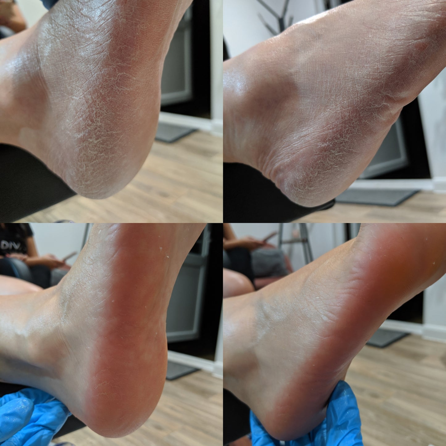 LOVASKIN ESSENTIEL DUO XL - Peeling instantané pour les pieds 250 ml et Hydratation instantanée 250 ml