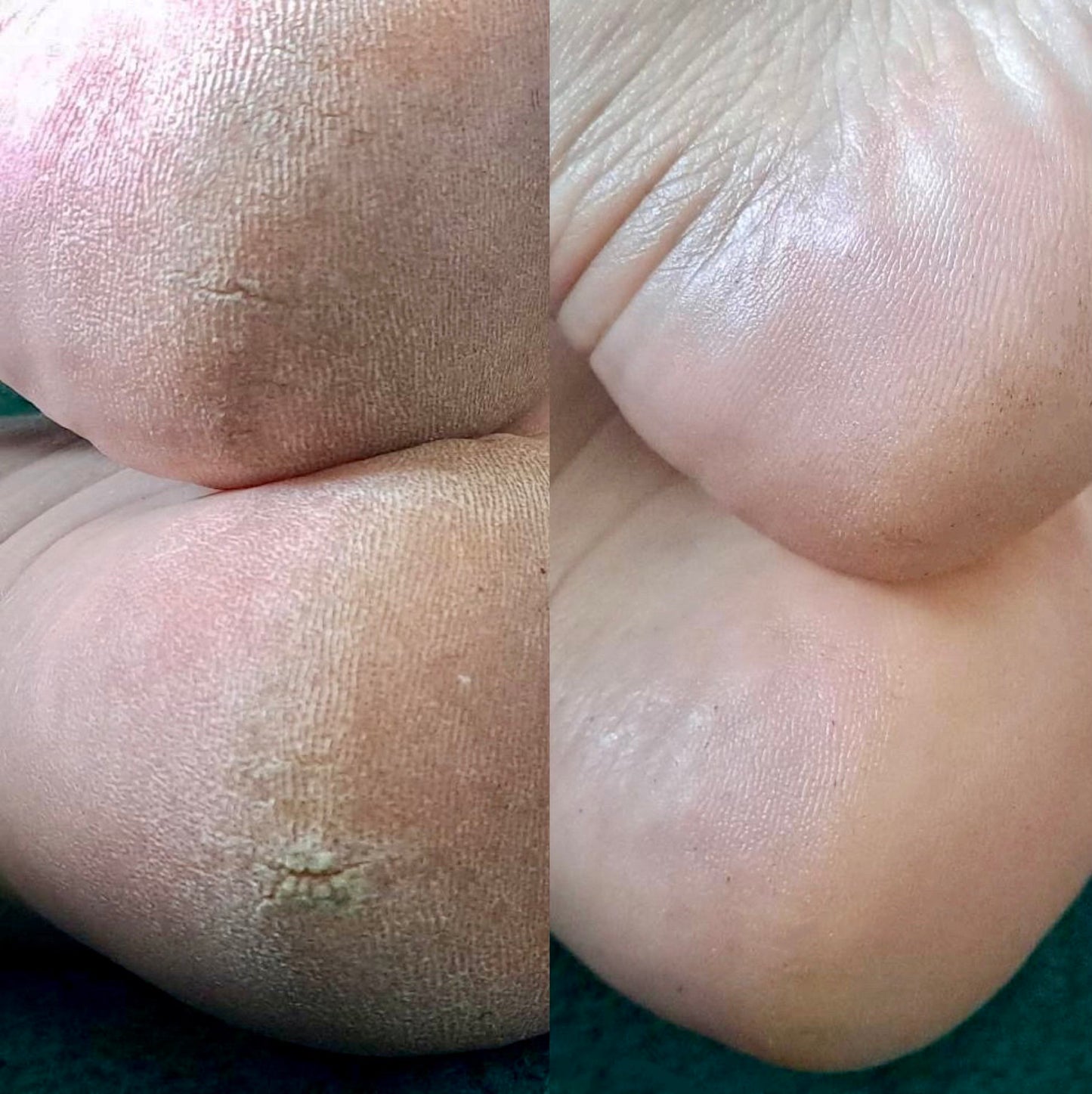 LOVASKIN INSTANT FOOT PEEL XL - een sprayflacon van 75 ml en een navulflacon van 250 ml