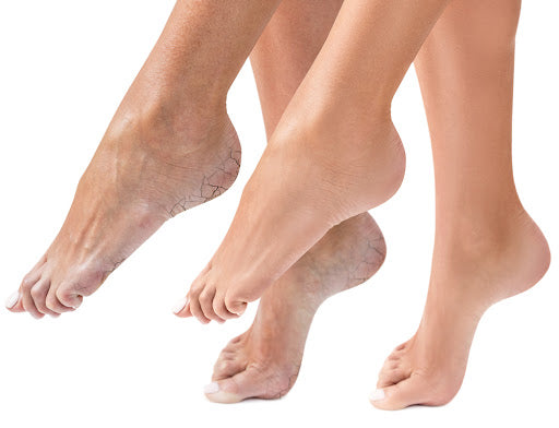 WHY ARE MY FEET SO DRY? WE EXPLORE THE REASONS FOR DRY SKIN