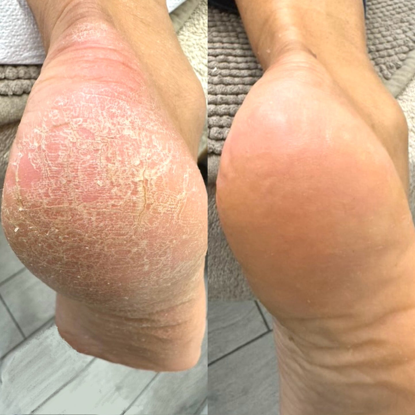 LOVASKIN Duo Essentiel - Peeling Instantané 75 ml avec Hydratant Instantané 50 ml